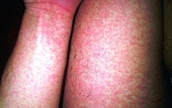 Gần 32.000 ca mắc, 4 ca tử vong: Bệnh viện Bạch Mai phát cảnh báo về 1 căn bệnh đang tăng nhanh, có thể suy đa tạng chỉ trong vài ngày