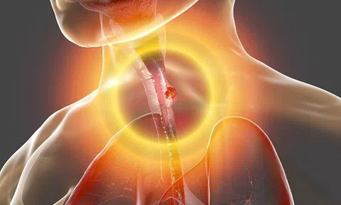 Thói quen ăn uống tưởng chừng vô hại âm thầm phá hủy tế bào, gia tăng nguy cơ ung thư thực quản