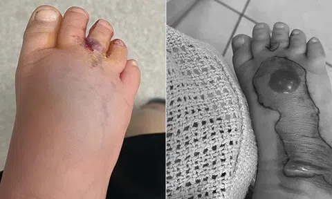 Chỉ một vết mèo cào tưởng vô hại, em bé phải cắt bỏ một phần chân khiến phụ huynh sợ hãi