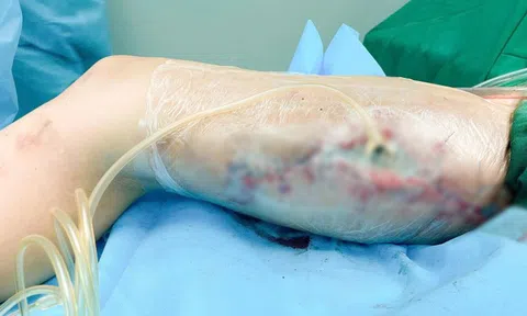 Tiêm filler toàn thân, cô gái trẻ hoại tử đùi, trải qua 60 ca mổ khóc lóc cầu cứu bác sĩ: "Khâu lại giúp, con đau lắm"