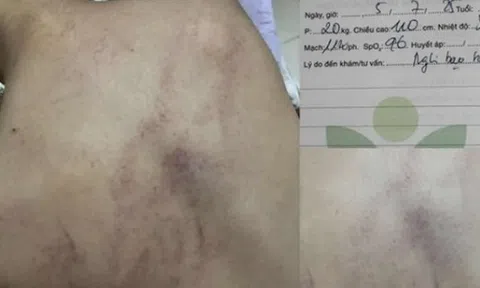 NÓNG - Vụ bé gái 4 tuổi bị cô giáo ném vào tường, đánh tím lưng: Bộ Y tế vào cuộc!