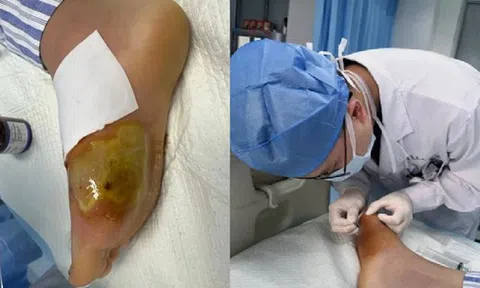 Suýt mất cả bàn chân vì giẫm phải cây tăm