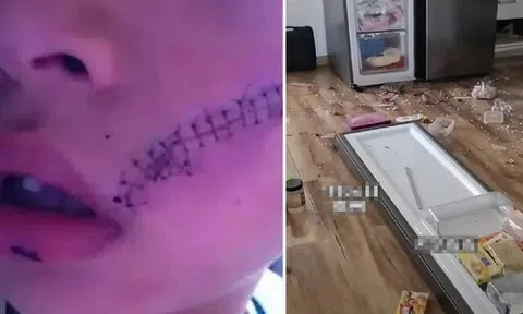Mở tủ lạnh, bé trai 6 tuổi phải khâu 38 mũi trên mặt