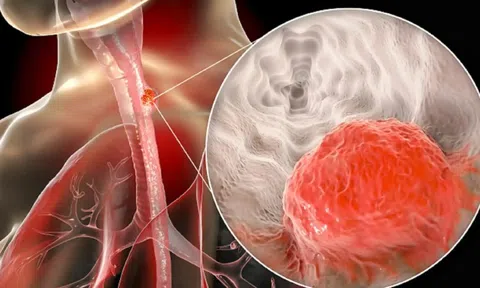 Nam giám đốc bất ngờ phát hiện ung thư giai đoạn 3: Hối hận vì đã bỏ qua 1 dấu hiệu suốt nhiều năm