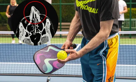 Người đàn ông TP.HCM gãy xương mũi vì chơi Pickleball