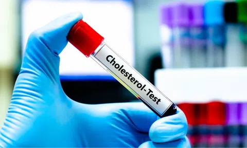 Mỡ máu cao vút bất ngờ hạ về mức bình thường: Bác sĩ thốt lên "5 thói quen này rất đáng học hỏi”