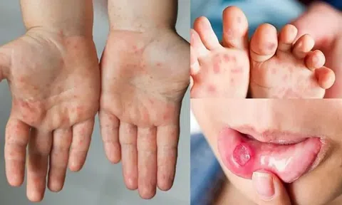 Nguy cơ dịch chồng dịch ở TP.HCM, ghi nhận hơn 3.000 ca một tuần