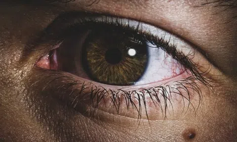 Tưởng nốt ruồi lộc trên mắt hoá ra mắc UNG THƯ DA, bác sĩ sửng sốt: Sai lầm chết người khi coi thường một ‘dấu chấm nhỏ’