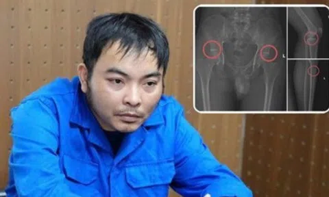 Cựu nhân viên y tế đục vỡ xương trục lợi bảo hiểm: Thủ đoạn tàn nhẫn, bất nhân