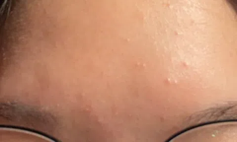 Con gái mọc mụn trứng cá, mẹ xin nghỉ phép đưa con đi cấp cứu