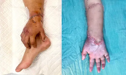 Bàn tay đứt lìa của mẹ bầu được nối lại sau thời gian 'nuôi' ở chân