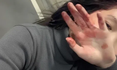 6 bất thường ở bàn tay đang ám chỉ lượng đường trong máu vượt ngưỡng an toàn, tiếc là rất ít người để ý!