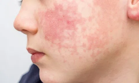 8 dấu hiệu ban đầu của "căn bệnh dễ lây lan nhất thế giới": Xuất hiện TRƯỚC cả khi phát ban, trẻ dưới 5 tuổi có nguy cơ cao nhất