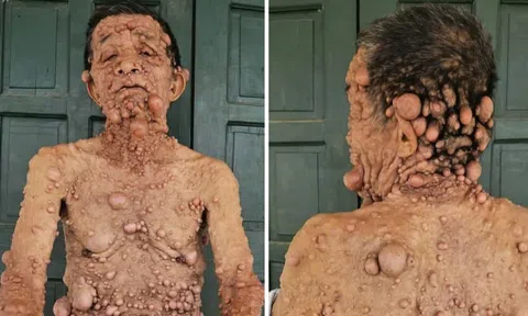 Cụ ông nổi u cục khắp người bị cắt chế độ khuyết tật: Được nhận lại trợ cấp sau phản ánh của Người Đưa Tin