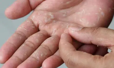 Khổ cả mùa đông vì da tay da chân bong tróc: Thói quen nhiều người vẫn làm mà không nhận ra đang tự làm đau mình