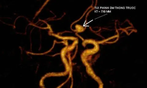 Đau đầu kéo dài, cô gái Hà Nội đi khám phát hiện phình mạch não, suýt đột quỵ