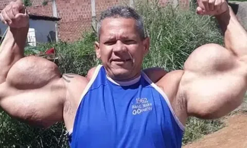 "Quái vật thể hình" Brazil sở hữu chu vi bắp tay lên tới 74cm đột ngột qua đời, bác sĩ cảnh báo 1 vấn đề sức khỏe tiềm ẩn