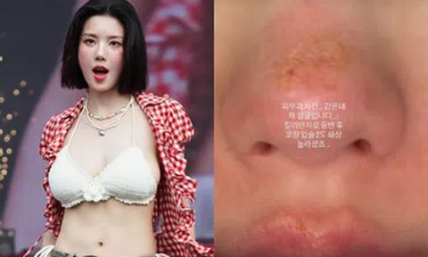 Nữ ca sĩ 31 tuổi bị bỏng nặng sau chuyến leo núi