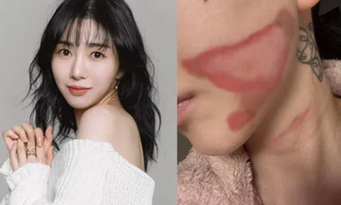 Gương mặt nữ ca sĩ 33 tuổi bị bỏng nghiêm trọng sau thẩm mỹ