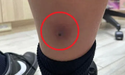 Tưởng chỉ là cúm mùa, bé trai 12 tuổi sốt trở lại: Bác sĩ vén ống quần kiểm tra liền yêu cầu cấp cứu khẩn cấp