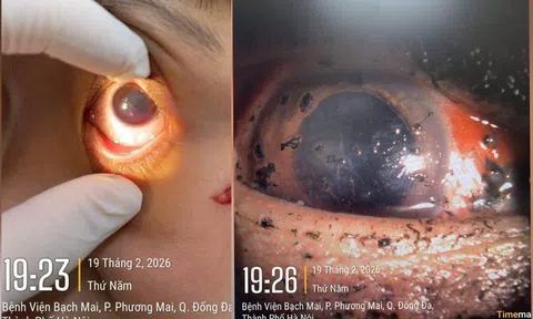Bệnh viện Bạch Mai cảnh báo 1 tình trạng bệnh ở mắt tăng vọt ngay trong 3 ngày đầu năm 2026