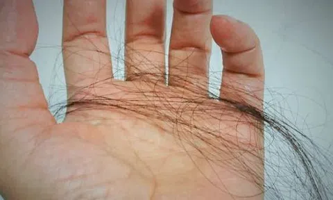 Một phụ nữ giảm được 10kg nhưng lại bị hói đầu: Bác sĩ tiết lộ 4 nguyên nhân chính không ai ngờ