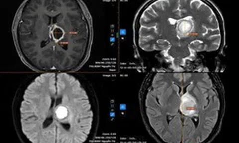 Thường xuyên buồn ngủ, đi khám “sốc” nặng khi biết nguyên nhân