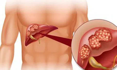 Cảnh báo từ WHO: 1 loại ĐỘC TỐ gây ung thư ẩn trong nhiều thực phẩm quen thuộc mà người Việt ĂN MỖI NGÀY