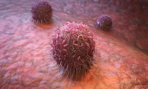 Loại ung thư đứng đầu số ca mắc ở Việt Nam, có thể di căn nhanh: 3 dấu hiệu ban đầu ai cũng nên biết