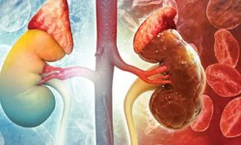 Suy thận có thể tấn công bất ngờ không báo trước: Đây là 4 đối tượng cần đặc biệt cảnh giác