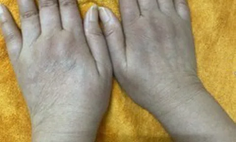 Nữ doanh nhân có 1 dấu hiệu lạ ở tay nhiều năm: Đi khám bác sĩ cảnh báo hàng loạt tạng đang "gặp nguy"