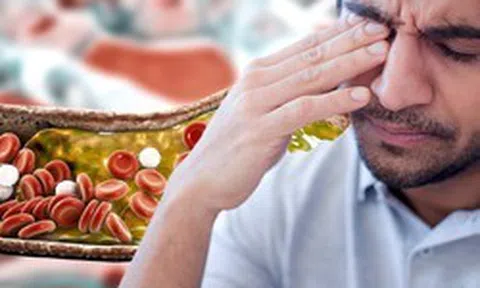 Nhìn vào mặt cũng có thể biết mỡ máu cao hay không: Nếu thấy 2 dấu hiệu này, hãy đi khám ngay