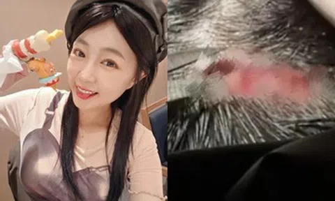 Nữ diễn viên 38 tuổi ngã đập đầu, khâu 5 mũi ngay sinh nhật