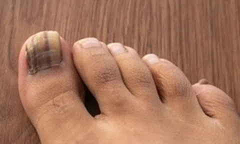 Dấu hiệu ở móng chân cảnh báo loại ung thư nguy hiểm: Nhiều người bỏ qua, bác sĩ khẩn thiết nhắc nhở