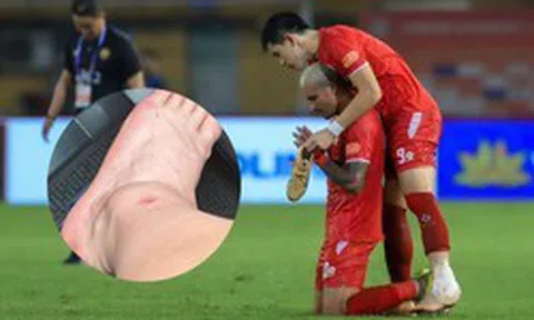 Đình Bắc lộ ảnh cổ chân sưng biến dạng sau trận vô địch V.League cùng CLB CAHN