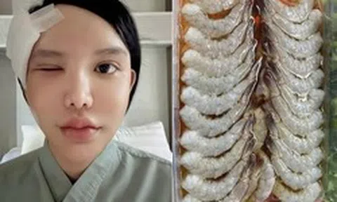 Người phụ nữ bị ký sinh trùng bò vào hốc mắt, suýt mù, bác sĩ cảnh báo 1 thói quen nhiều người Việt mắc phải