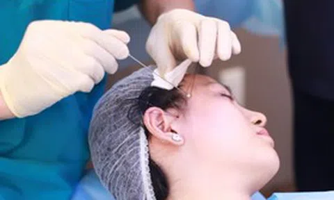 Trào lưu tự căng da mặt tại nhà gây sốc: Nhiều cô gái đối mặt nguy cơ hủy hoại gương mặt