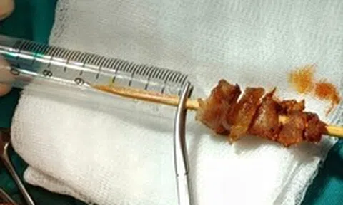 Kích hoạt toàn Bệnh viện Việt Đức cấp cứu bé gái 2,5 tuổi bị que xiên thịt đâm sâu, nguy cơ xuyên sọ não