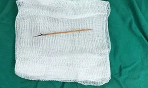 Bác sĩ sốc khi phát hiện chiếc tăm tre cắm trong tim bé trai 13 tuổi