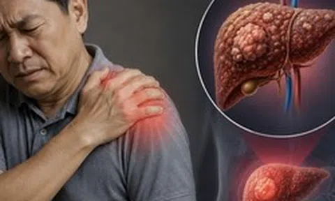 Cảnh báo 1 TÍN HIỆU cực quan trọng của ung thư gan: Nhiều người còn cố cãi chỉ đau vai thông thường