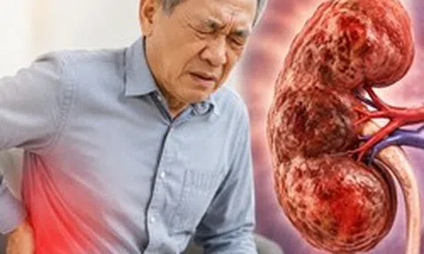 Bác sĩ chỉ: 6 DẤU HIỆU cảnh báo suy thận, nhưng dễ bị người Việt nhầm với vấn đề tuổi tác và mệt mỏi