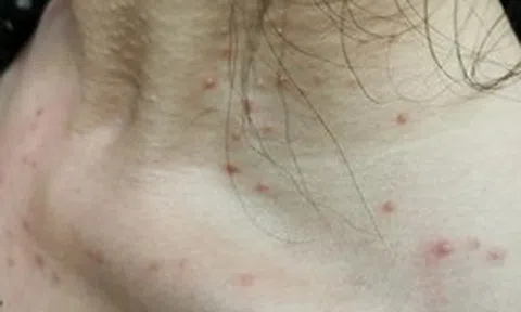 Cảnh báo: Các bệnh ung thư rất dễ "ngụy trang" dưới hình dạng của 4 loại mụn này