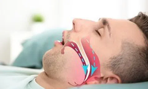 Ngáy to bị vợ giục đi khám, phát hiện căn bệnh có thể dẫn đến đột quỵ