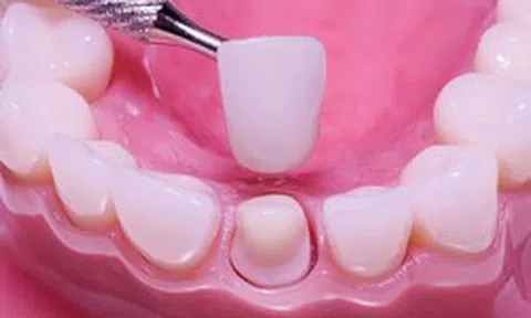 Vì sao nhiều người bọc răng sứ xong bị hôi miệng?