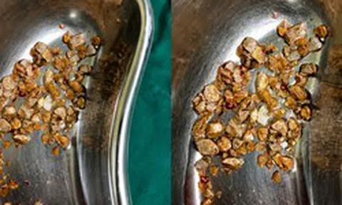 Nam kỹ sư 35 tuổi nhập viện vì sỏi chất đầy thận sau khi bỏ trà sữa, uống thứ nước lành mạnh để giảm cân