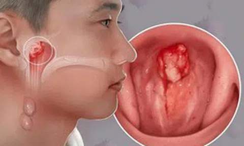 Con bị ù tai thôi mà... và cú sốc của gia đình khi bé trai 14 tuổi được chẩn đoán ung thư giai đoạn tiến triển