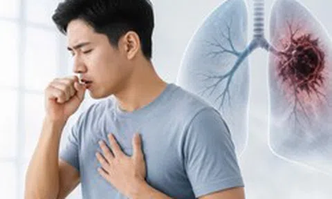 Không phải cơn ho: Bác sĩ cho biết ngón tay đôi khi là nơi đầu tiên cảnh báo ung thư phổi