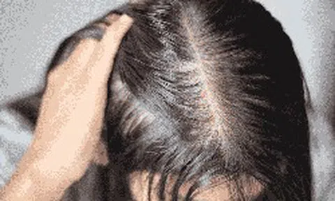 Tưởng stress vì thi cử nên rụng tóc, cô gái 22 tuổi phát hiện căn bệnh đang âm thầm đang phá hủy thận