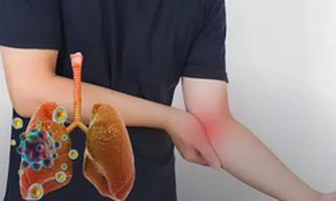 Ung thư phổi thường được chẩn đoán ở giai đoạn muộn: Nếu cảm thấy "1 chỗ sần sùi, 1 chỗ tê bì và 2 cơn đau", hãy đi khám sớm