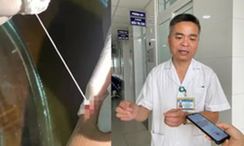Phát hiện ca giun rồng thứ 44 tại Việt Nam: Người đàn ông ở Lào Cai có vết "mụn" ở cánh tay, nặn ra 2 đoạn giun dài tới 20cm